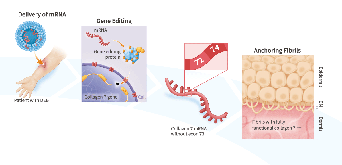 Gene-Editing Therapies for Epidermolysis Bullosa (EB)